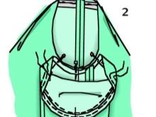 Inserting Sleeves - Step 2