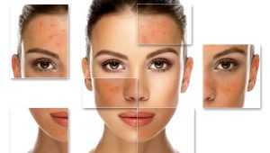 Salicylic peeling: features and rules of use