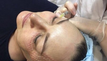 Papler efter biorevitalisering: hvorfor vises de, og hvornår forsvinder de?