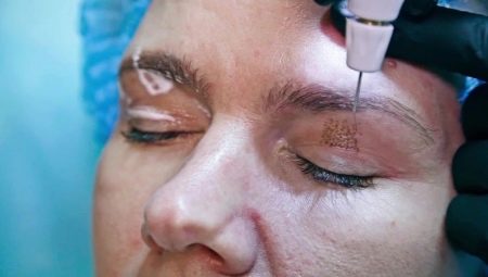 Plasma blepharoplasty: what is it?