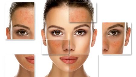 Salicylic peeling: features and rules of use