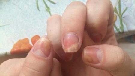 Onycholysis after application of gel polish