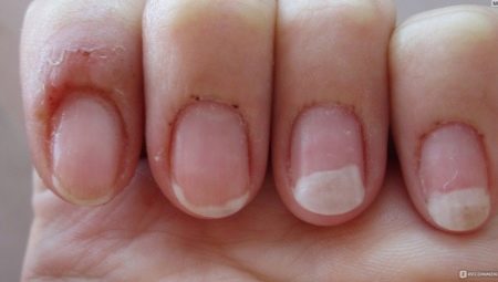 Gel polish allergy: causes, symptoms and treatments