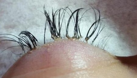 Unsuccessful eyelash extensions: causes and consequences