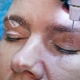 Plasma blepharoplasty: what is it?