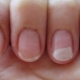 Gel polish allergy: causes, symptoms and treatments